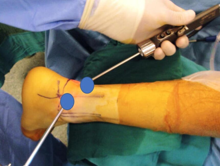 Posterior Ankle Arthroscopy/Hind Foot Endoscopy