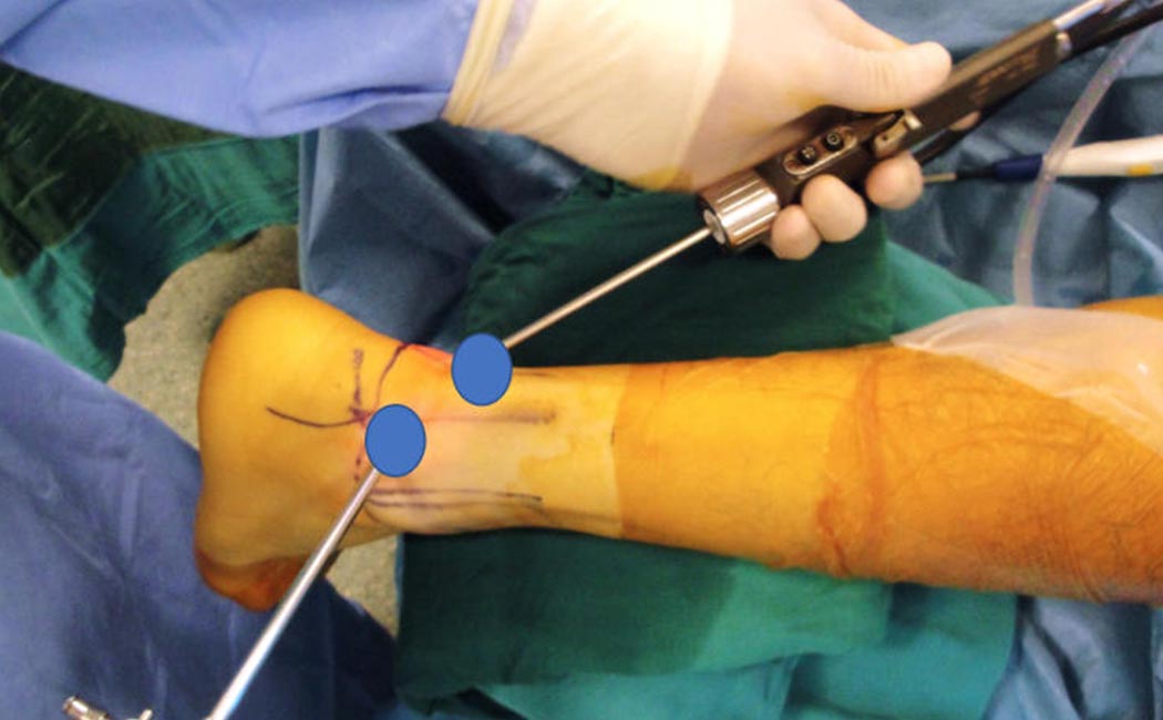 Posterior Ankle Arthroscopy/Hind Foot Endoscopy